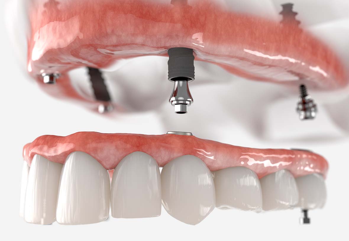 Implant Supported Dentures in Prince Hart Dental